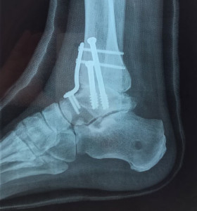 My Ankle X-Ray