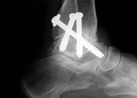 X-Ray of post op ankle fusion.