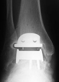 X-Ray post opp ankle replacement